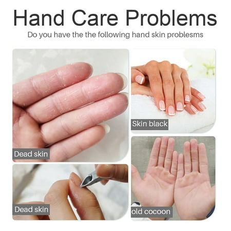 dead skin on hands