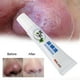 thumbnail image 4 of Crema para el tratamiento de la rosácea, gel limpiador antibacteriano para eliminar el enrojecimiento de la nariz, producto para el cuidado de la piel, 4 of 13