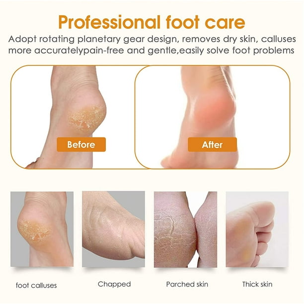 Dr scholl's callus remover hotsell walmart
