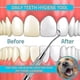 thumbnail image 3 of Professional Tartar Scraper Tool -double Ended Tartar Remover For Teeth(pack Of 2) (hy), 3 of 3