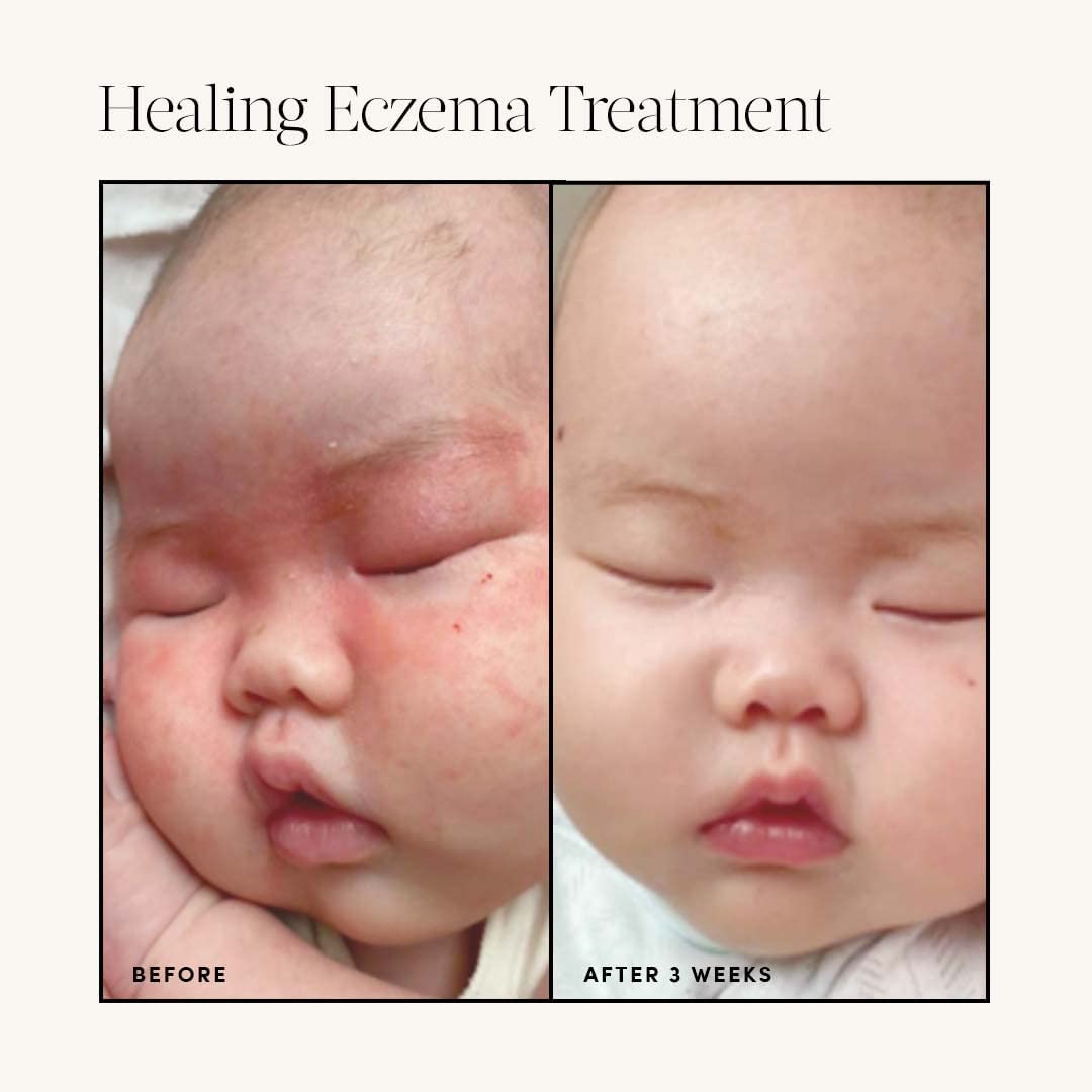 Evereden Healing Eczema Treatment, 1.7 fl oz | Safe & Efficient Eczema Cream | Gentle & Fragrance Free Eczema Cream for Babies, Kids, and Adults