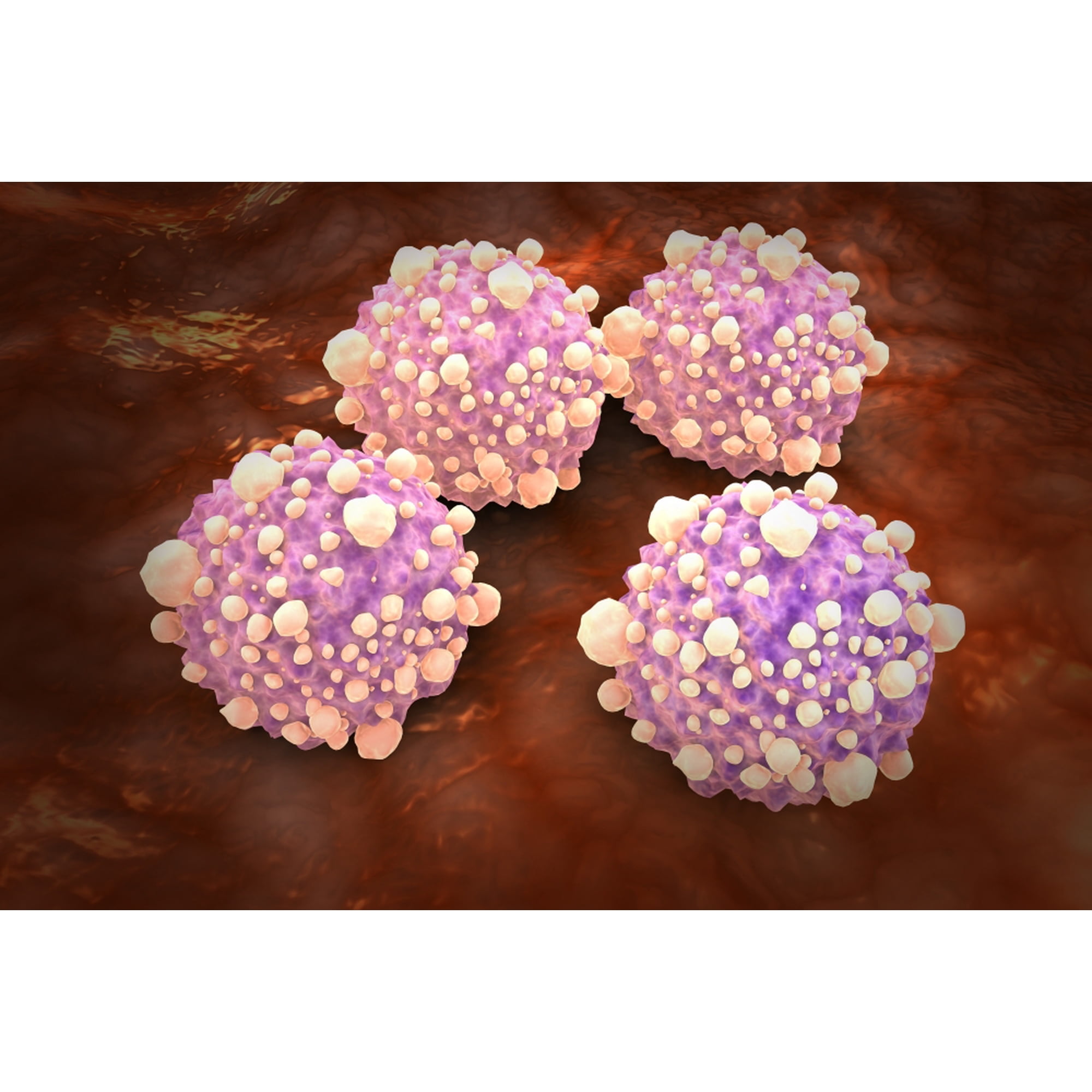 Microscipic view of pancreatic cancer cells Canvas Art - Stocktrek Images (35 x 24)