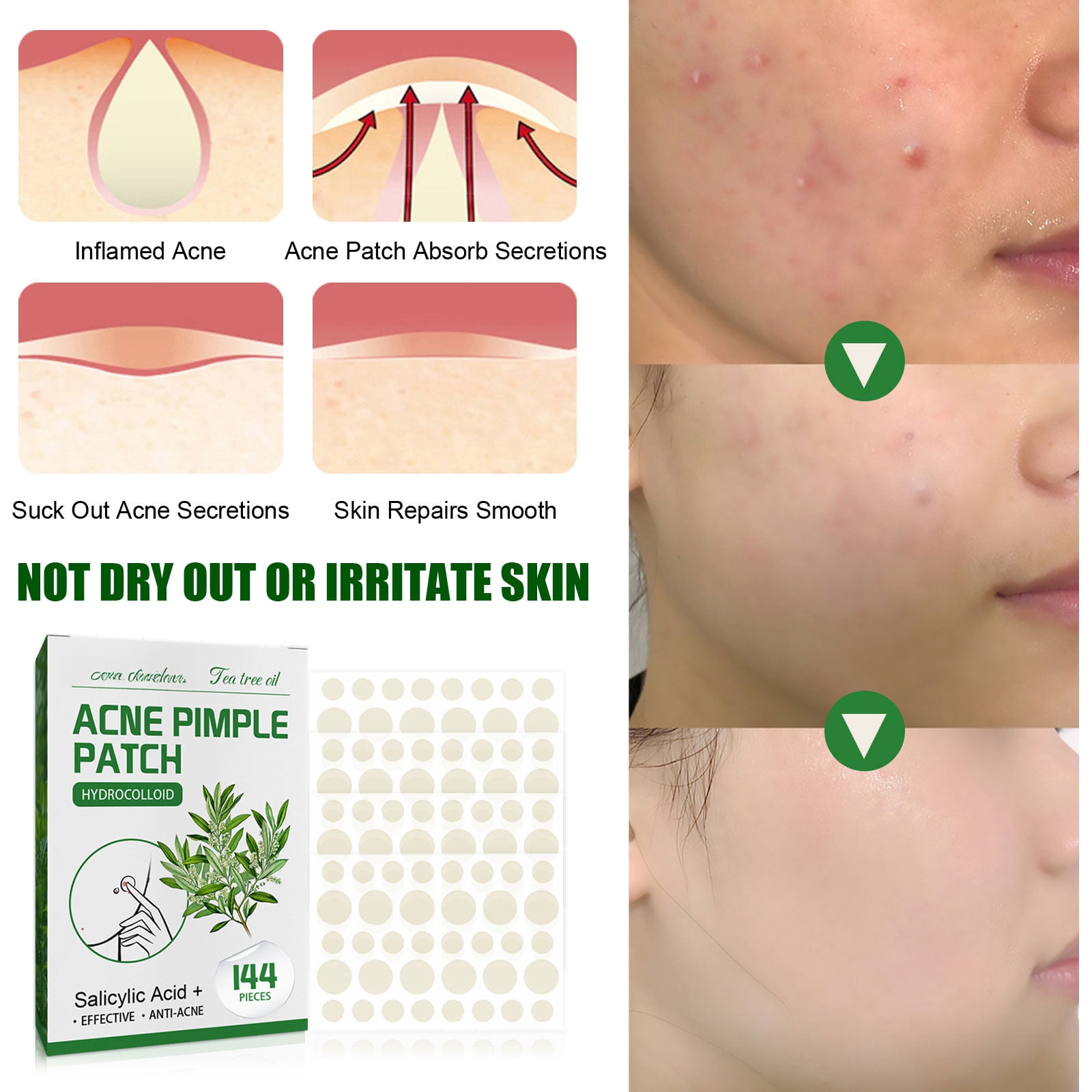 Alvantor Invisible Tea Tree Oil Hydrocolloid Pimple Patches for Face, 144pcs - Waterproof & Breathable