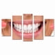 thumbnail image 1 of Juego de Cuadros Decorativos, Sonrisa Perfecta y Radiante, Estilo Estética Dental, 5 Piezas, Ideal para Clínicas de Diseño de Sonrisa, 150x80cm, 1 of 5