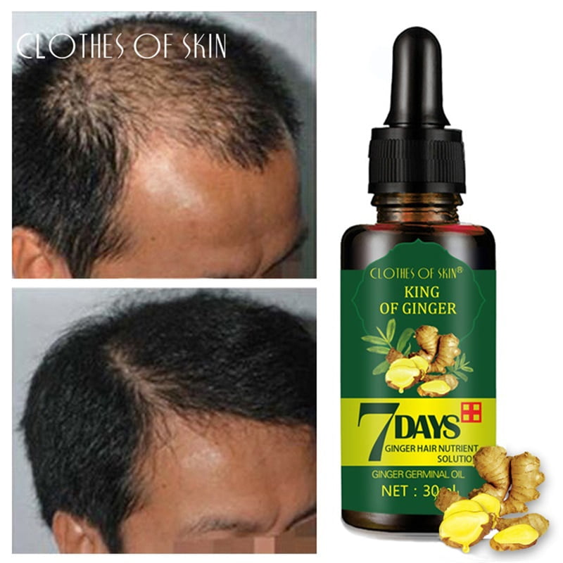 Upgrade Hair Loss Treatment Ginger Hair Growth Serum For ...