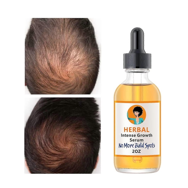 Sérum de jengibre para el crecimiento del cabello, para la caída del cabello y la caspa, tratamiento para el crecimiento del cabello, 59 ml (2 oz), para hombres y mujeres.