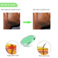 thumbnail image 3 of Ingrown Hair Remover, Razor Bumps Keratosis Pilaris KP Repair, 3 of 4
