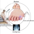 thumbnail image 2 of 10-pack Little Toe Splint, Gel Toe Separator, Little Toe Straightener Hammer Toe (purple), 2 of 5