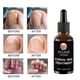 thumbnail image 3 of Esencia de reparación de uñas por hongos, tratamiento para el cuidado de los pies, dedo del pie, 30ml, 3 of 5