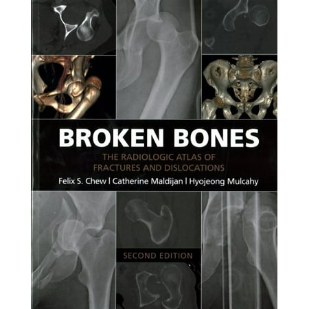 Broken Bones : The Radiologic Atlas of Fractures and