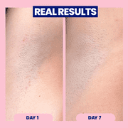 Megababe Après Shave, Ingrown Hair & Razor Bump Liquid Roll-on Treatment, 3 fl oz