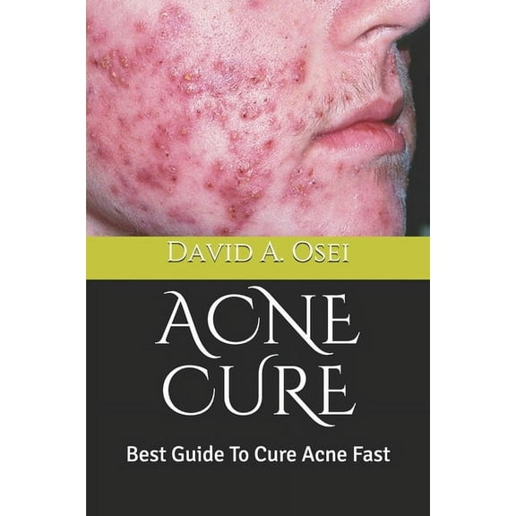 Acne Cure: Best Guide To Cure Acne Fast (Paperback)