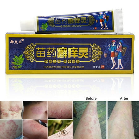 Antipruritic Herbal Cream Skin Problem Psoriasis Treatment Ointment ...