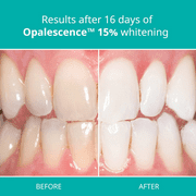 Opalescence 15% Gel Syringes Teeth Whitening Refill Kit (4 Pack / 8 Units) Mint Sensitivity Fluoride
