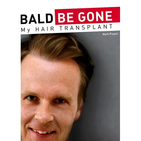 Bald Be Gone - My Hair Transplant - eBook (Hair Transplant Types The Best One)