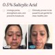thumbnail image 3 of Limpiador facial MdAcne Hidratante con ácido salicílico 0,5% 60 ml, 3 of 6