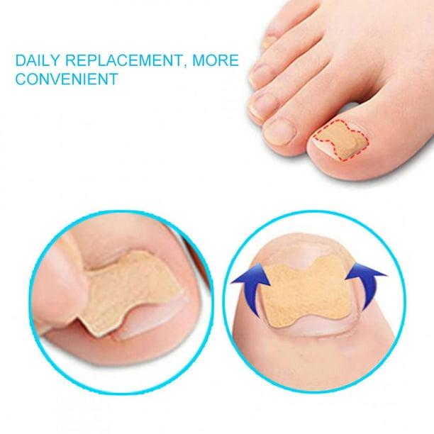 Parche corrector para uñas de los pies, parche corrector para uñas encarnadas, parche para pedicura para uñas de los pies, adhesivo para pedicura diseñado a medida para la perfección