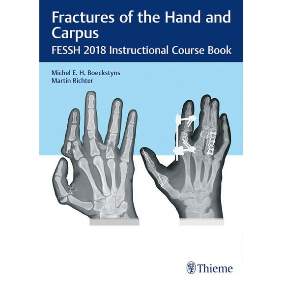 Fractures of the Hand and Carpus: Fessh 2018 Instructional Course Book, (Hardcover)
