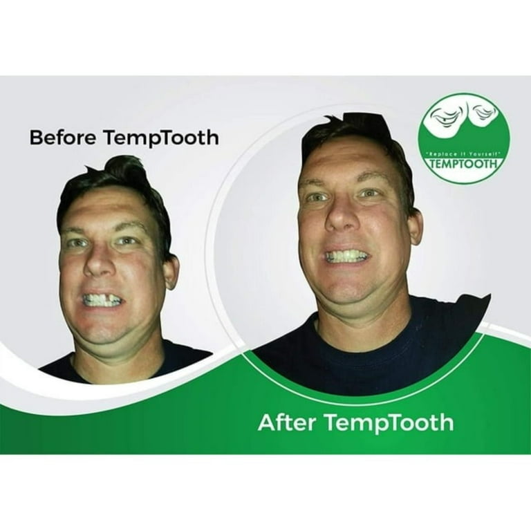 Temporary tooth repair kit #foryou #tooth #temporarytooth