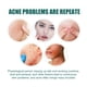 thumbnail image 3 of Limited time offer!Star Acne Patch Pimple Acne Spots Pimple Marks Cover Acne Pimple Patch, 3 of 8
