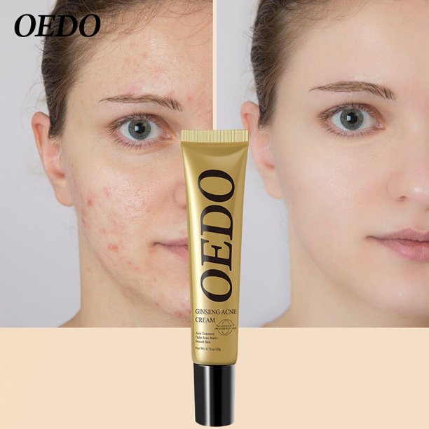 AUQUEST-crema facial para tratamiento del acné, aceite de ácido salicílico, blanqueador de Contro, encoge los poros, belleza, salud, Cosméticos coreanos, cuidado de la piel"one" Fivean LED