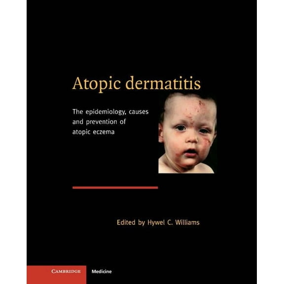 Atopic Dermatitis, (Hardcover)