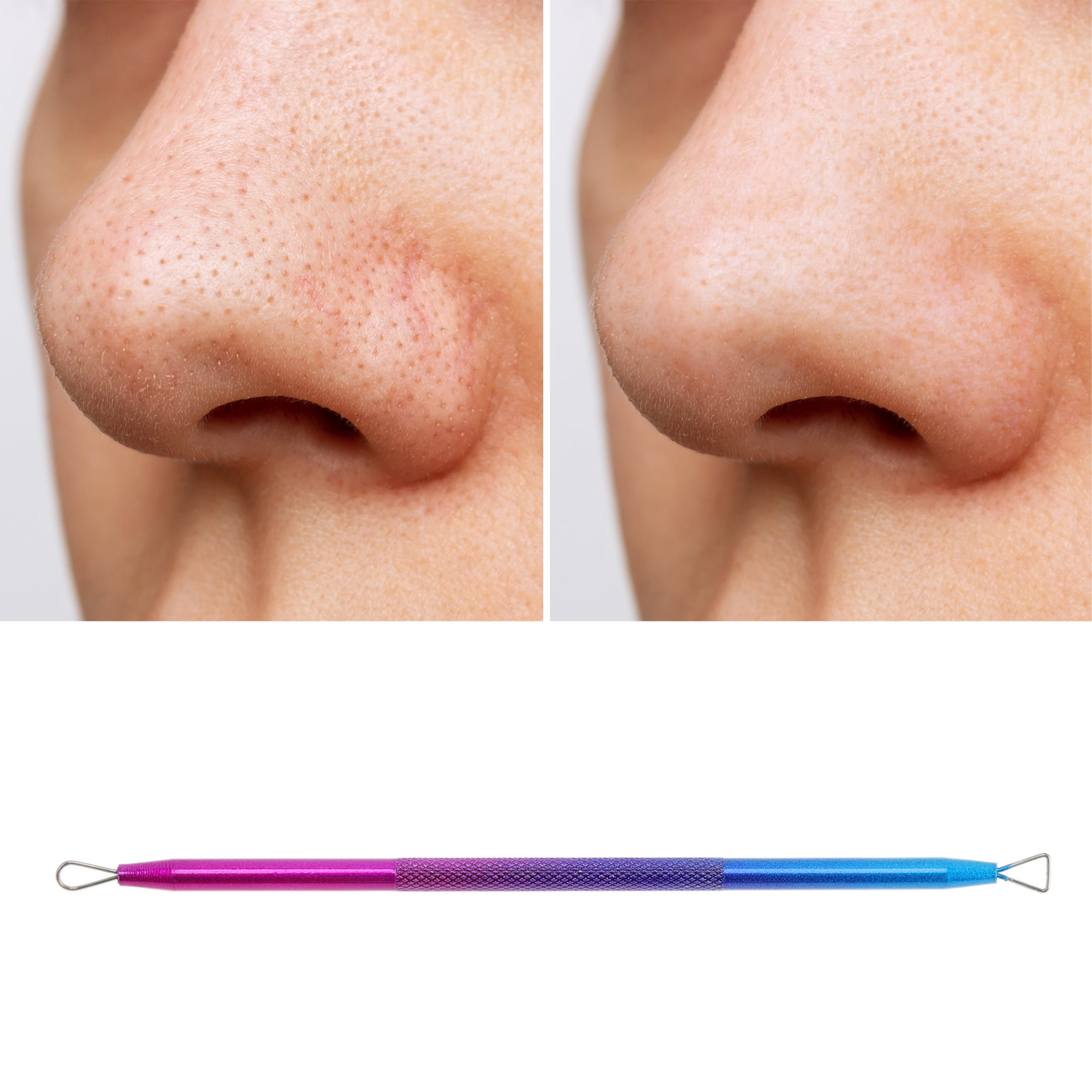 Unique Bargains 1pc Durable and Professional Pimple Extractor Tool Blue Purple