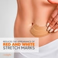 thumbnail image 3 of Cicatrissim White Stretch Mark Cream Kit, Body Moisturizer for White Striae, All Skin Types, 2 x 5.3 oz, 3 of 9