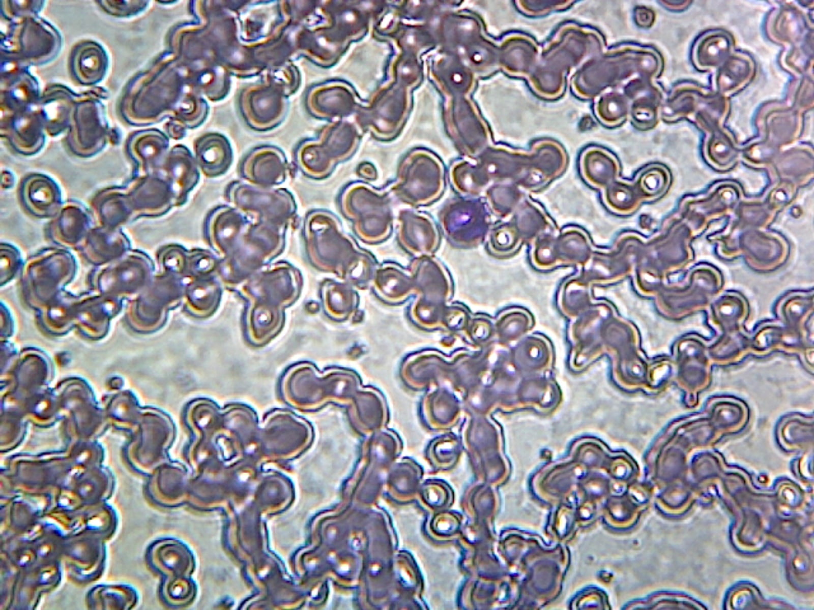Iron-Deficient Anemia Blood (Human); Smear; GS Stain; Showing Peripheral Blood Film with Small ...