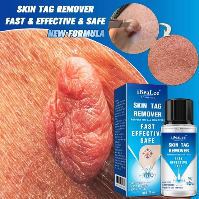 IBeaLee Cross border Wart Removal Liquid, Youfu Flat Liquid, Huangzi Point Mole Liquid, Chicken Eye Filament Flat Youde Removal Liquid