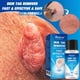 thumbnail image 1 of IBeaLee Cross border Wart Removal Liquid, Youfu Flat Liquid, Huangzi Point Mole Liquid, Chicken Eye Filament Flat Youde Removal Liquid, 1 of 5