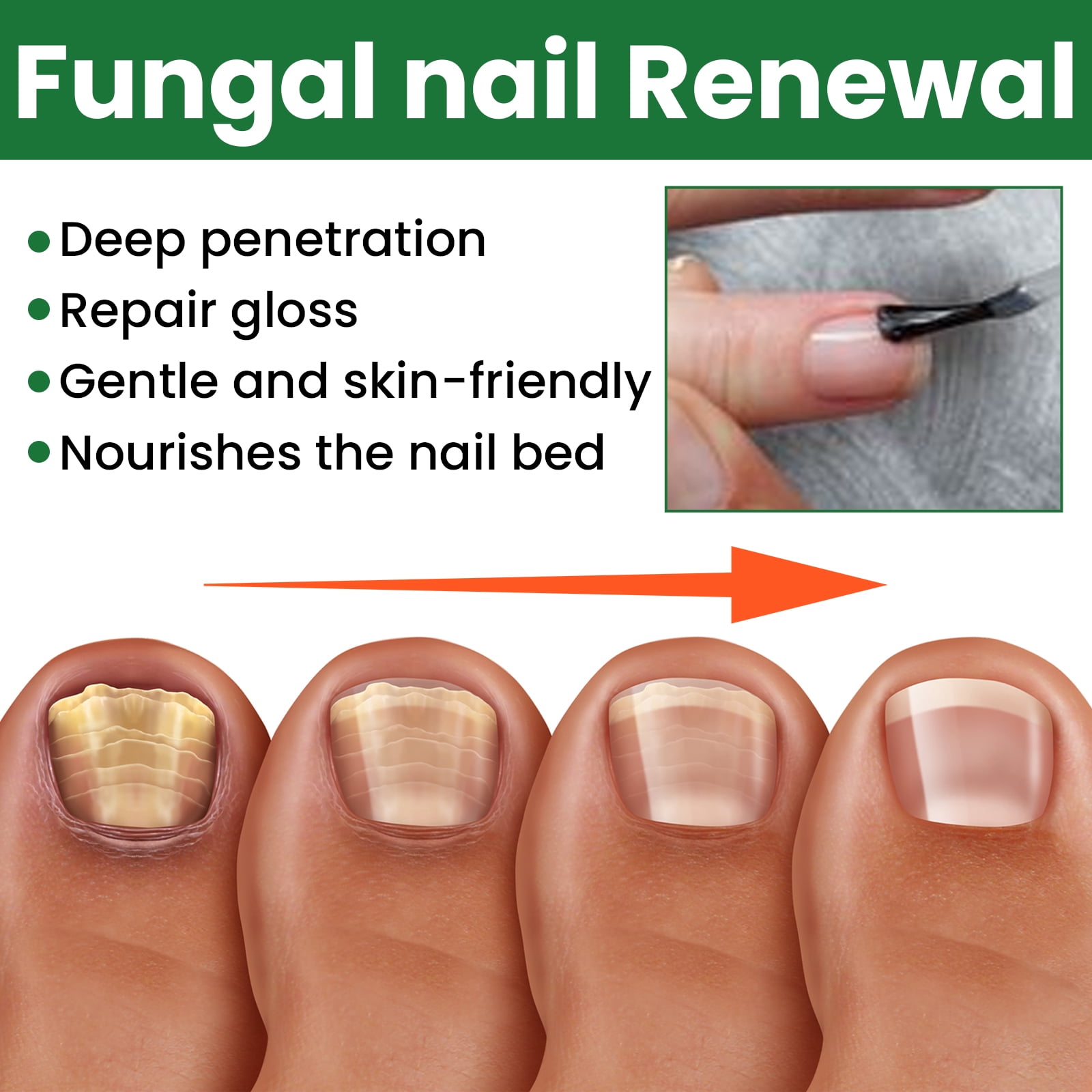 Alvantor Nail Repair For Fungal Treatment, Gray Removing Nourishing Lotion For Hands and feet, 1 fl oz