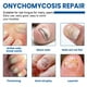 thumbnail image 4 of Parches de hongos de uñas XIMONTH 32 parches para hongos en las uñas de los pies dañadas, nutritivos, hidratantes, reparadores de uñas de los pies, 4 of 8