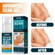 thumbnail image 5 of Advanced Scar Gel Scar Repair Cream Face Remove Acne Smoothing Blanqueamiento Ndcxsfigh Nuevos Originales, 5 of 9