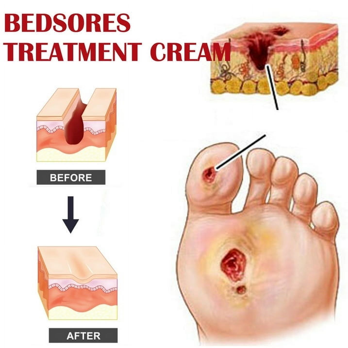 Decubitus Cream Pressure Sore Ulcer Skin Relief Ointment Bed Sore Wound Healing Treat Anti Dry Repair Moisturizing Body Care 20g