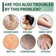 thumbnail image 2 of Crema de vitíligo, tratamiento de vitíligo para el vitíligo de la piel, crema de salud de vitíligo para reducir las manchas blancas y mejorar la pigmentación de la piel, 2 of 3