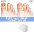 thumbnail image 4 of Láseres para el Tratamiento de Hongos en las Uñas, Limpieza de Dispositivos, Onicomicosis, Reparación Hongos en las Uñas, Eliminación Hongos en las Uñas, Tratamiento Antihongos., 4 of 5