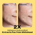 thumbnail image 3 of Parche protector contra el acné AVARELLE ZITOUT Hydrocolloid 40 parches, 3 of 8