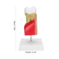 thumbnail image 4 of Dents Standard, Modèle de Dent Cariée, Env. 10 X 5,5 X 4 Cm Résine à Structure Réelle + Matériau Abdominal pour Hôpital de Dentiste à Domicile, 4 of 8