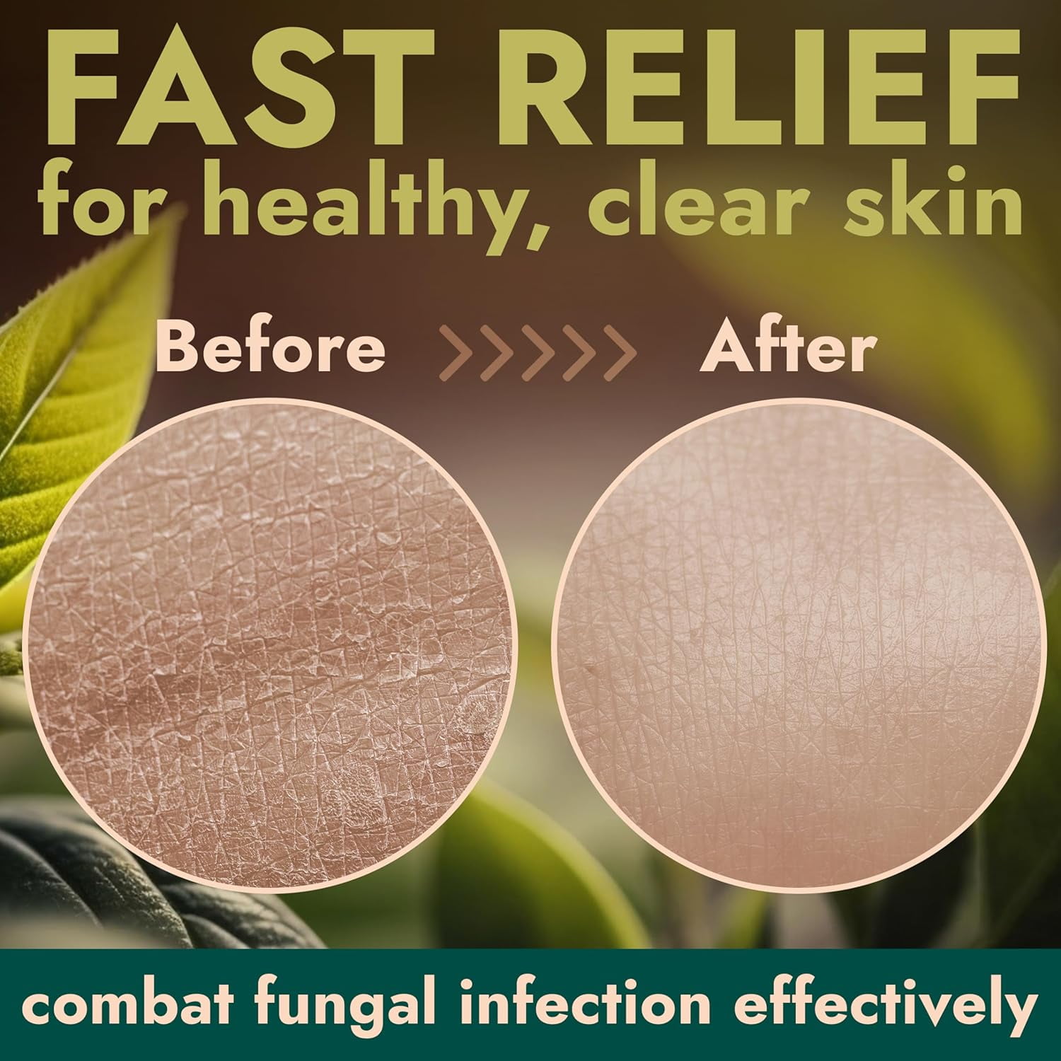 Antifungal Body Wash with Tea Tree Oil | Antifungal Soap Treats Ringworm, Back Acne, Eczema & Jock Itch | Antifungal Body Soap For Men And Women (16.9 oz)
