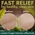 thumbnail image 2 of Antifungal Body Wash with Tea Tree Oil | Antifungal Soap Treats Ringworm, Back Acne, Eczema & Jock Itch | Antifungal Body Soap For Men And Women (16.9 oz), 2 of 5
