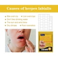 thumbnail image 3 of South Moon 60 parches Parche de miel para herpes labial Tratamiento de ampollas Oculta Protege Calma y oculta el herpes labial, 3 of 5