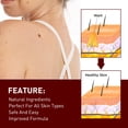 thumbnail image 4 of Removedor rápido para eliminar todos los lunares, verrugas, pecas, callos en los pies, verrugas, papilomas, eliminar rápidamente los lunares, 3ml, 4 of 5