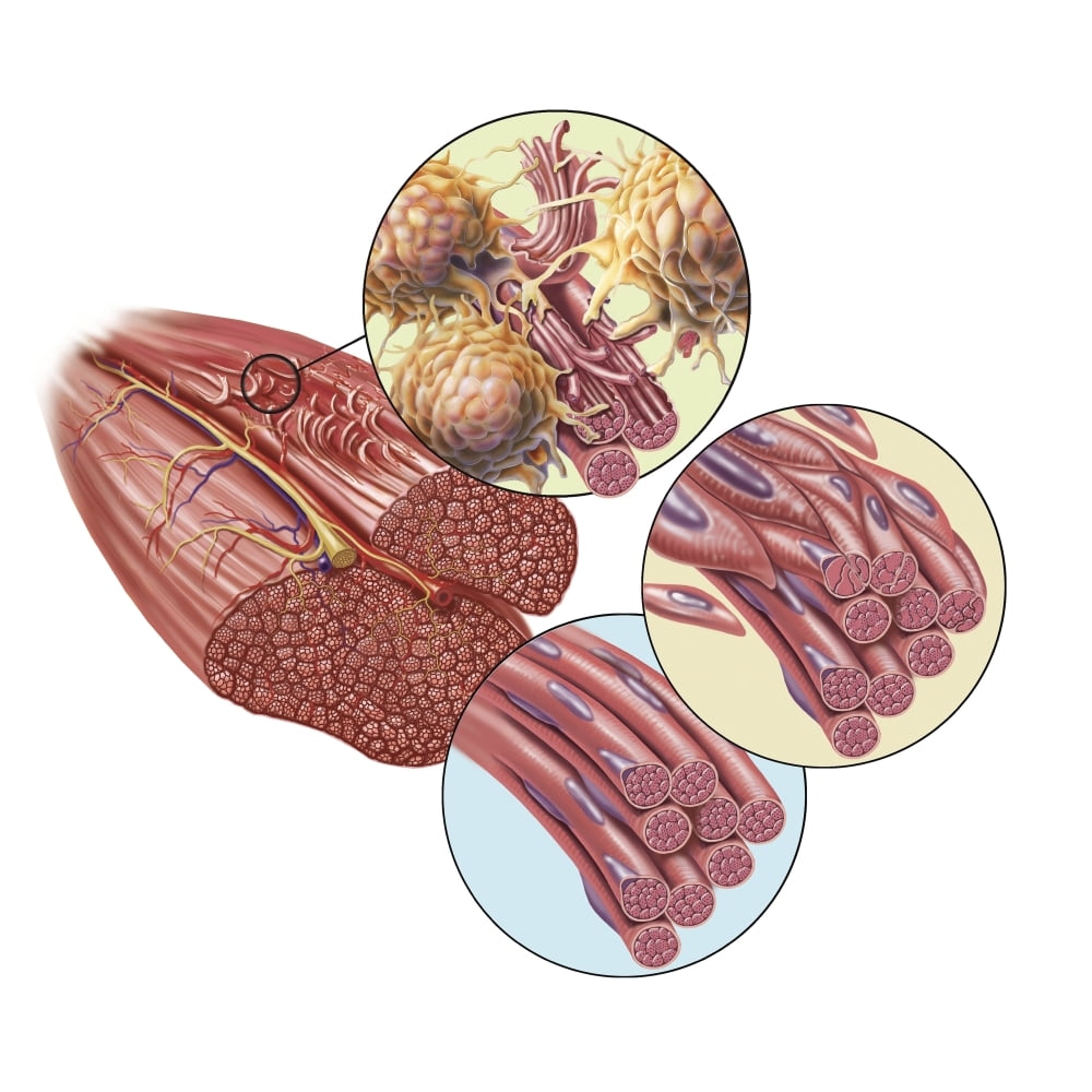 Torn muscle fibers with healing stages surrounding. Poster Print by