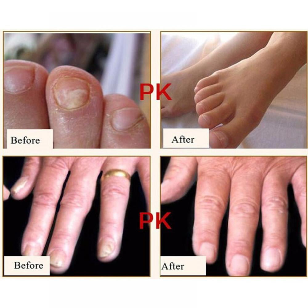Natural Herb Nail Repair Cream,Nail Fungus Treatment Onychomycosis  Paronychia Anti Fungal Repair Toe Nail Foot Care 
