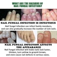 thumbnail image 4 of 2x 30ml Ginger Nail Treatment Nail Support Nail Care, 7 Days Nail Treatment Serum, Multi-Purpose Nail Repair Fungal Anti-fungus Liquid, 4 of 5