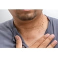 thumbnail image 2 of Solución Removedora de Verrugas 9ml Certus Pharma Certus Pharma Essential Health Care, 2 of 3
