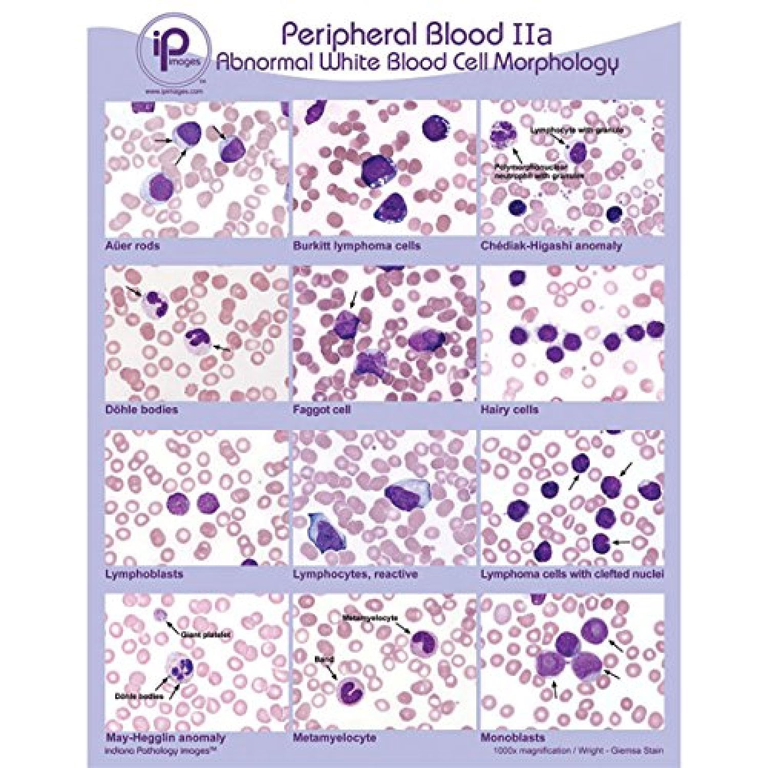 Wbc 6 10 Abnormal Meaning – Leukocytes in Urine: What Do They Mean? – RRSWP