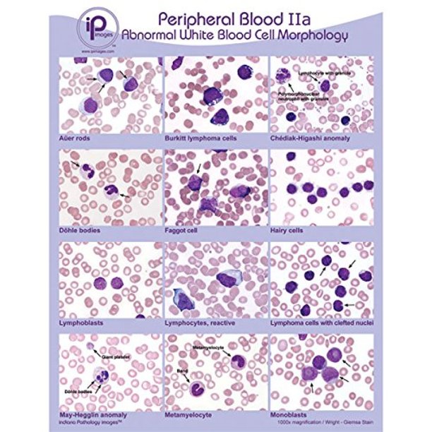 Peripheral Blood Poster Abnormal WBC Morphology Poster, Superior design ...