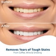 Burst Whitening Strips: Before & After Photos - 37rv2pg